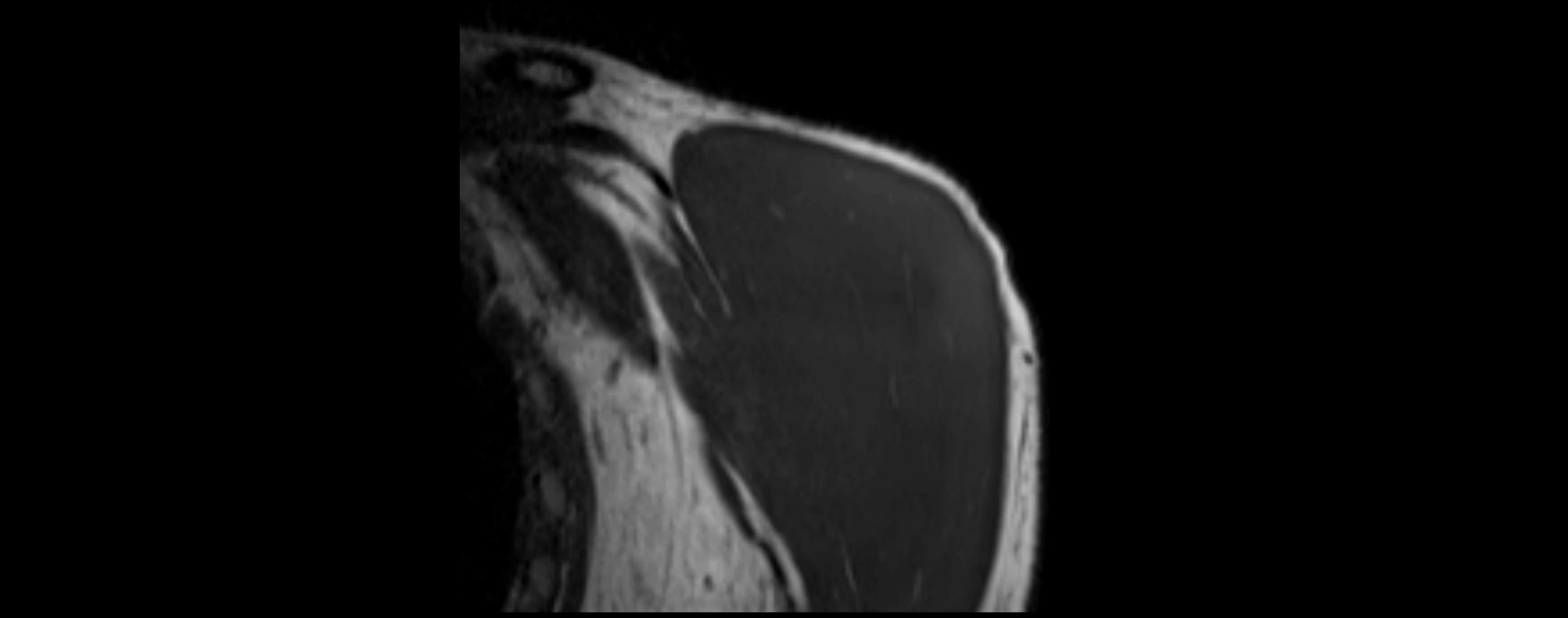 shoulder ligments coronal  cross sectional anatomy 3T MRI AI enhanced radiology image -img-00001-00001.webp